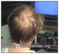 strip excision surgery