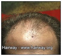 hair restoration surgery