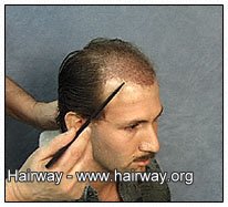 hair transplant after surgery