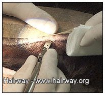 strip excision hair transplant